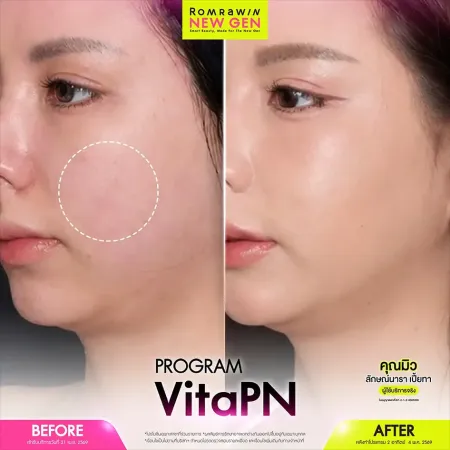 รีวิว Before After โปรแกรม Vita PN (Vitaran) ลดรอยแดง ฟื้นฟูผิวแพ้ง่ายฉ่ำวาว