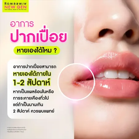 ระยะเวลาแผลร้อนในสมานตัวและสิวริมฝีปากหายเอง