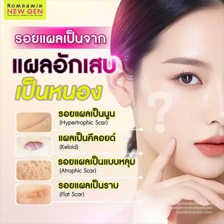 ประเภทของรอยแผลเป็นที่เกิดหลังจากแผลอักเสบหาย