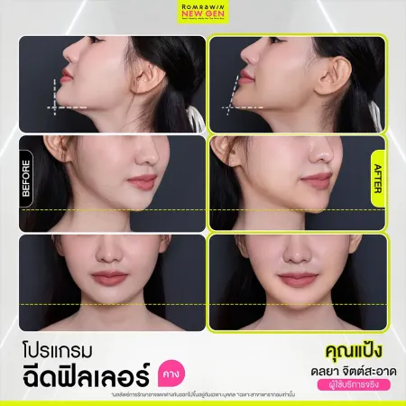 รีวิวฟิลเลอร์คาง ก่อนหลังทำ เคสคุณแป้ง ปรับคางยาว เสริมกรอบหน้าเรียวสวย