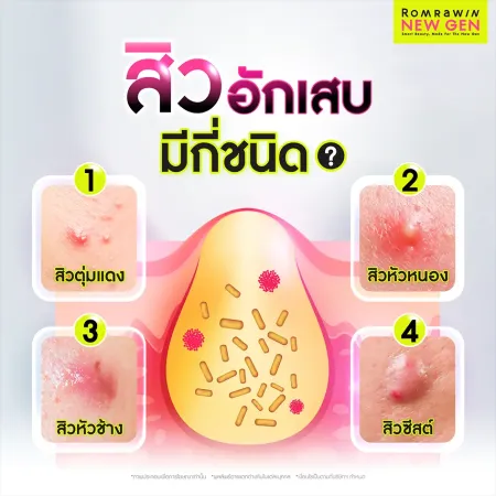 สิวอักเสบมีกี่ชนิด จำแนก 4 ประเภท สิวตุ่มแดง สิวหัวหนอง สิวหัวช้าง และสิวซีสต์