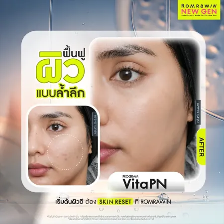รีวิว ก่อนหลังทำ Program VitaPN Vitaran ฟื้นฟูผิวล้ำลึก ลดรอยสิว ผิวเนียนใส