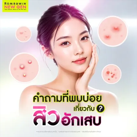 คำถามที่พบบ่อยเกี่ยวกับสิวอักเสบ ไขข้อสงสัยเรื่องวิธีรักษา และการดูแลผิว