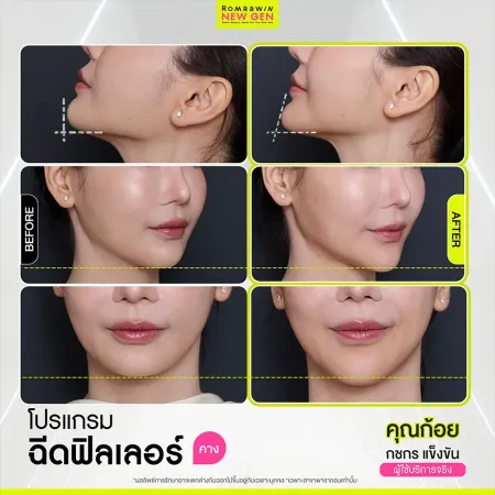 รีวิว Before After ฉีดฟิลเลอร์คาง คุณก้อย ปรับทรงคางได้รูป ปรับรูปหน้าเรียวสวย