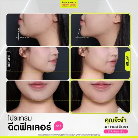 รีวิว Before After ฉีดฟิลเลอร์คาง คุณจ๊ะจ๋า ปรับทรงคางเรียวสวย หน้าละมุน