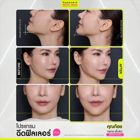 รีวิว Before After ฉีดฟิลเลอร์คาง คุณก้อย ปรับรูปหน้า V-Shape สวยสมดุล