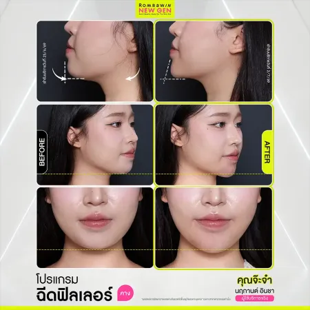 รีวิว Before After ฉีดฟิลเลอร์คาง คุณจ๊ะจ๋า ปรับรูปหน้า V-Shape ดูสมดุลละมุนขึ้น