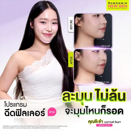 รีวิวฉีดฟิลเลอร์คาง คุณจ๊ะจ๋า คางสวยละมุนไม่ล้น กรอบหน้าชัดเป๊ะทุกมุม