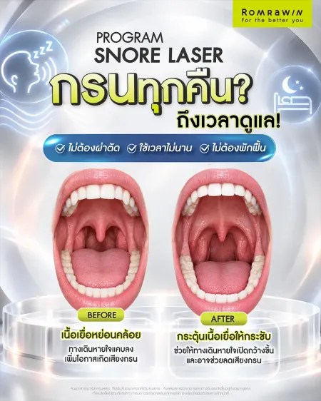 โปรแกรม Snore Laser ลดเสียงกรน เปรียบเทียบเนื้อเยื่อในช่องปากก่อนและหลังทำ
