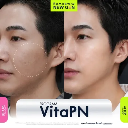 รีวิวผลลัพธ์ก่อนและหลังทำโปรแกรม VitaPN (Vitaran) ภาพเปรียบเทียบผิวหน้าผู้ชาย